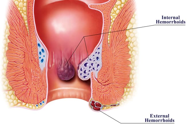 Ambeien, Hemoroid, atau Wasir